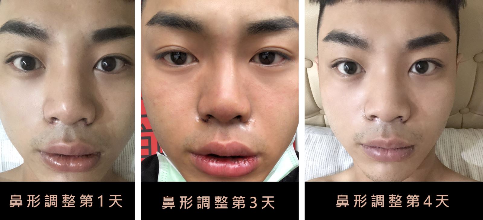 醫學美容 調整鼻形  挺鼻 楊氏羅丹 